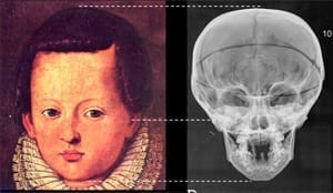 I bambini dei Medici affetti da rachitismo