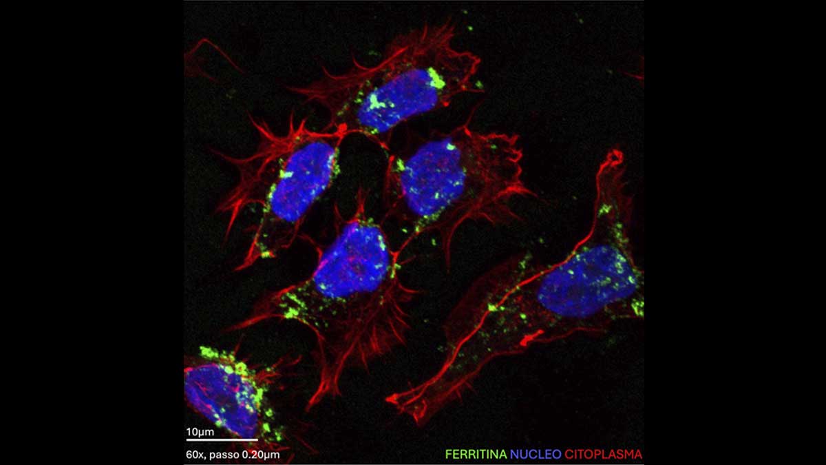 Un RNA svela il segreto del tumore cerebrale