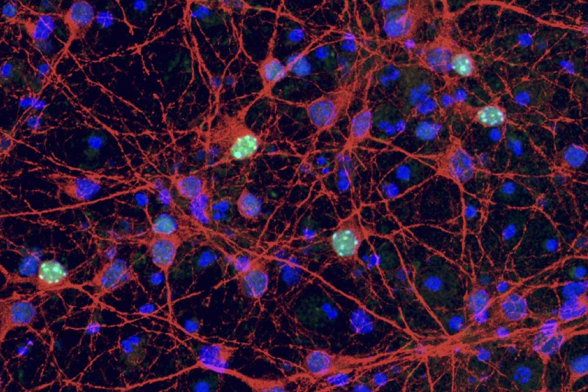 Nuove funzioni di MeCP2 riscrivono la ricerca terapeutica